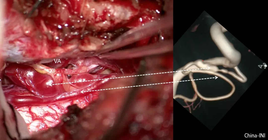 手术视野与血管造影对比:探查显露出血夹层动脉瘤及远端下降支(白色