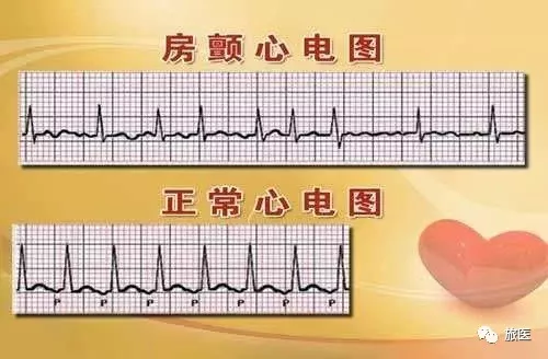 图片来源:网络 可以通俗地把房颤看作是心房快速又不整齐的"抖动".