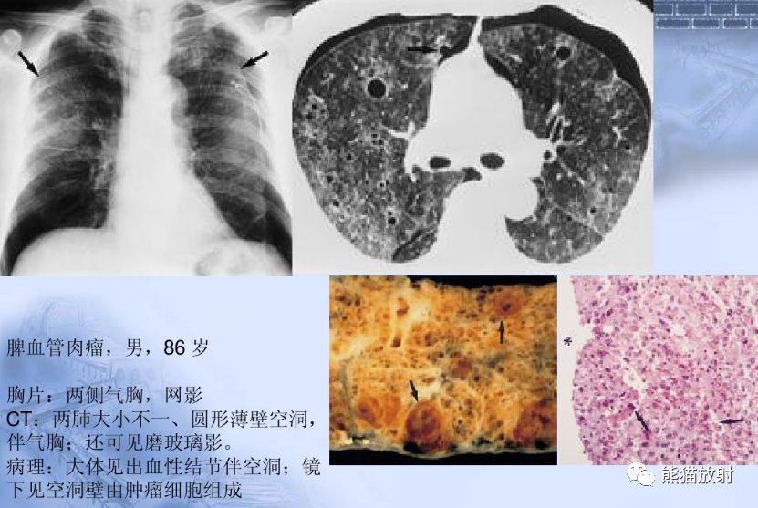 非典型肺转移瘤丨多种影像表现