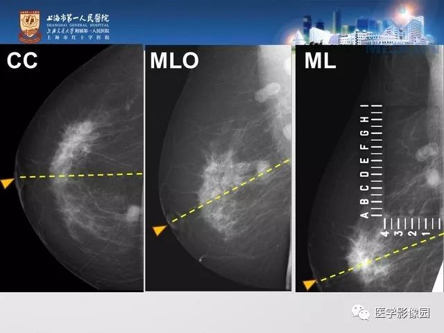 专家手把手教您x线摄影如何对乳腺病灶精确定位影像天地