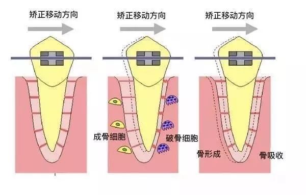 戴牙套什么原理_戴牙套的图片(3)