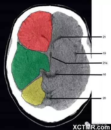 看完这个,再也不想找别的颅脑ct解剖了