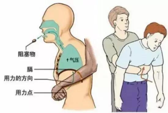 孩子吃饭时突然异物卡喉,家长都需学会的紧急5分钟急救方法