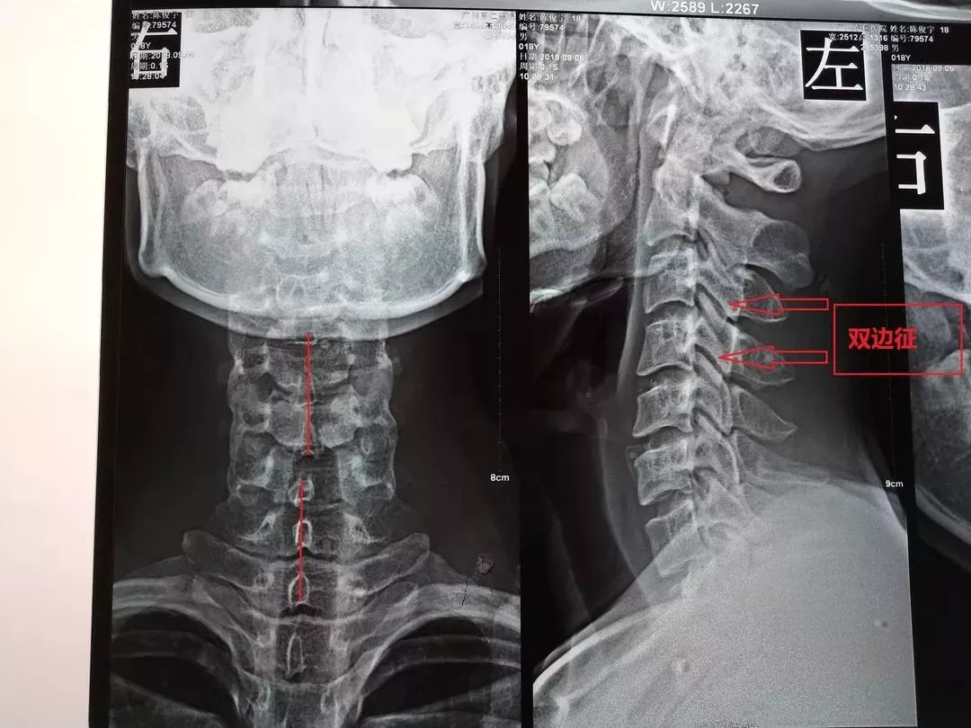 (1)x线:开口位见齿突尖与寰椎侧块不对称,骨折线;枢椎棘突偏歪;寰椎侧