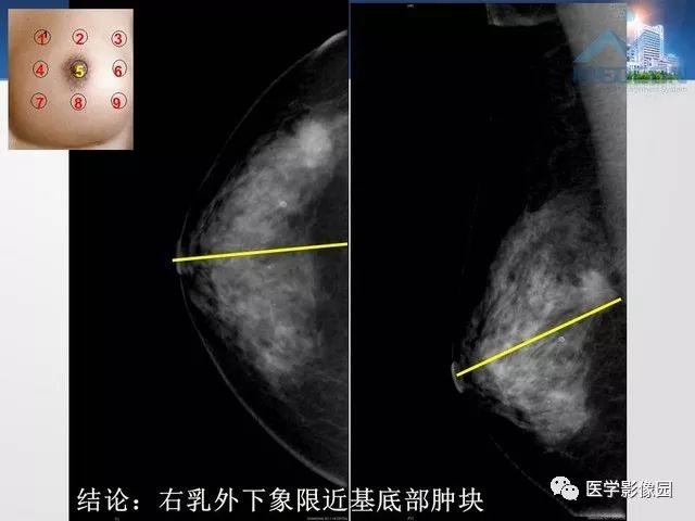 专家手把手教您x线摄影如何对乳腺病灶精确定位影像天地