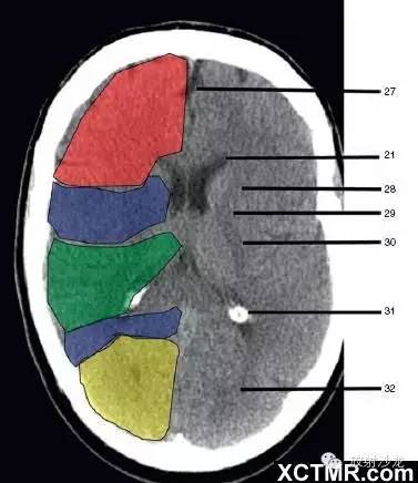 27,纵裂(interhemispheric fissure)