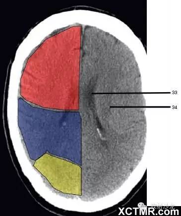 侧脑室枕角(occipital horn of lateral ventricle:绿色部分为颞叶