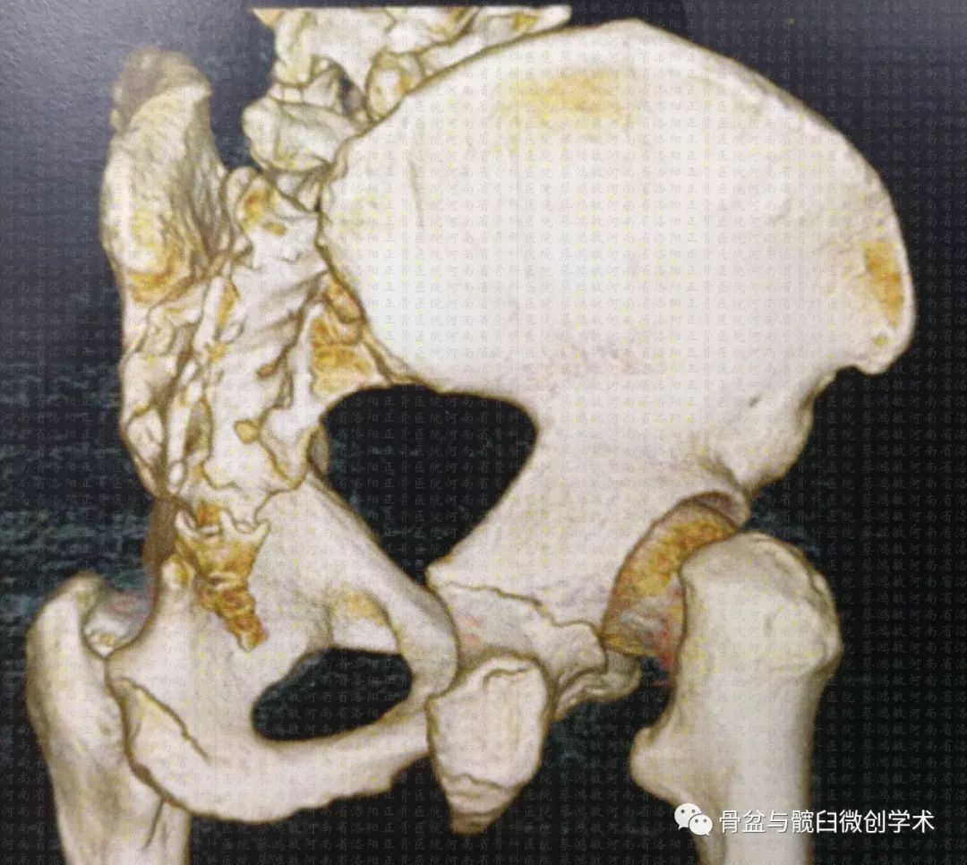 髋臼横形骨折的微创治疗经皮前柱后柱螺钉置入手术