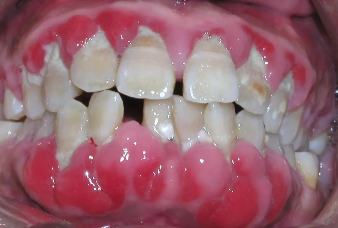 1,白血病 牙龈肿大,颜色暗红发绀或苍白;龈缘处组织坏死,溃疡,假膜