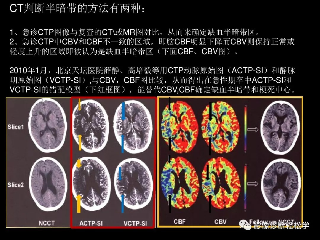 缺血性脑血管病的ct,mr灌注成像