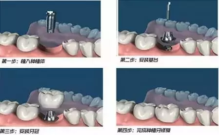 种植牙一般分为2个步骤:第一次植入人工牙根;第二次在已经稳固后的