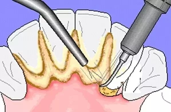 得了牙周炎该怎么办