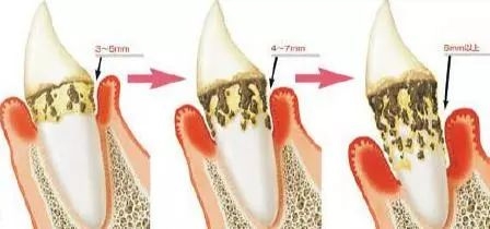 得了牙周炎该怎么办