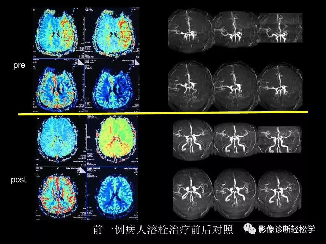 缺血性脑血管病的ctmr灌注成像