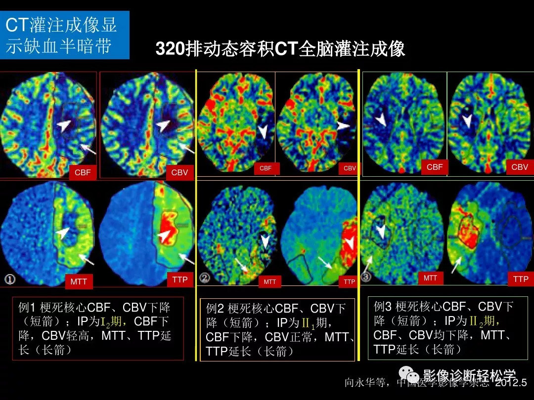 缺血性脑血管病的ctmr灌注成像