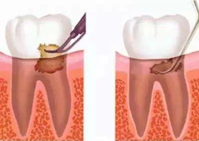 得了牙周炎该怎么办