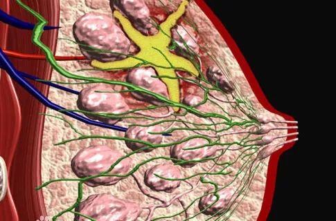 因为穿了不合适的内衣,压迫了乳房组织,影响乳腺和淋巴组织循环,就会