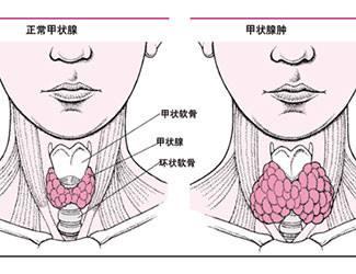 看图说话 甲状腺结节的临床症状与病因!