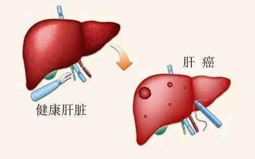 歌手臧天朔肝癌去世,哪些人容易被肝癌盯上?