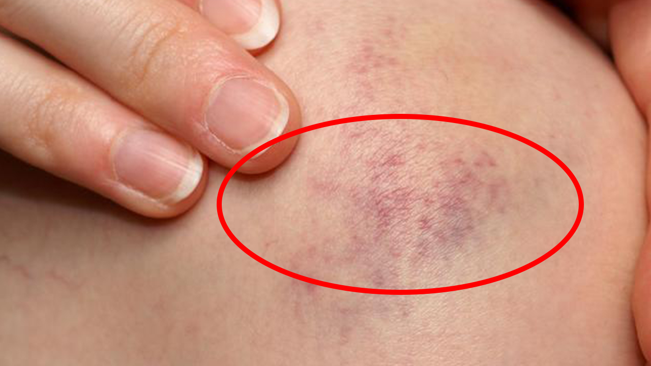 其实淤青发紫,是皮肤血管破裂出血导致的.