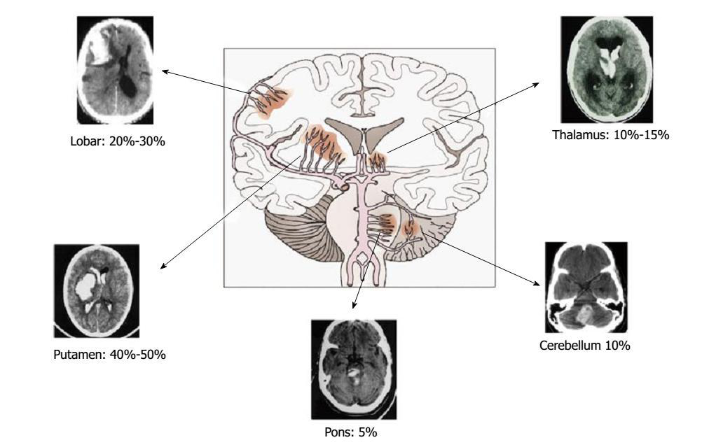解析脑出血的常见部位和临床症状_丘脑