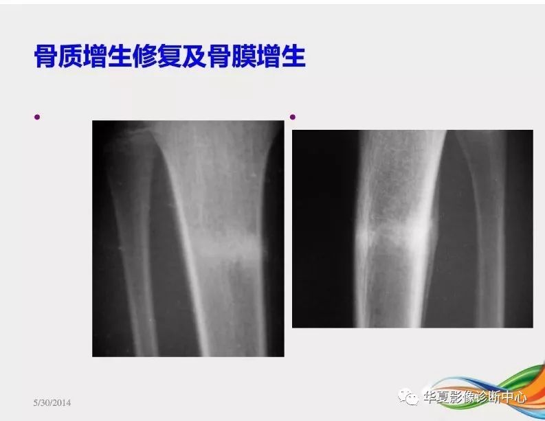 应力性骨折影像学诊断