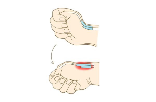 【杏林健康】拇指疼痛 小心腱鞘炎