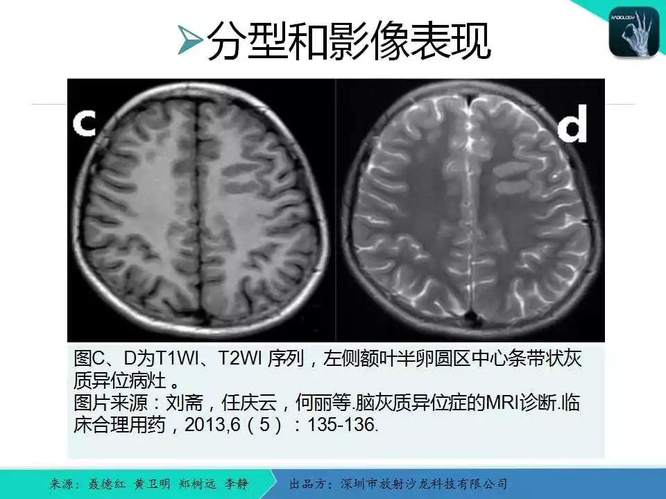 精品课件脑灰质异位症的影像诊断