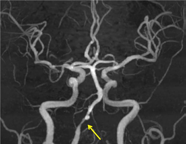 入院后核磁共振显示右侧椎动脉残余狭窄明显,伴有局部血管扩张