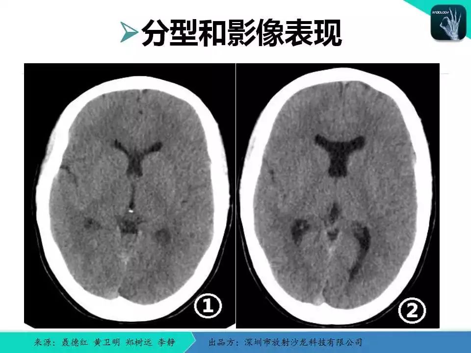 精品课件脑灰质异位症的影像诊断