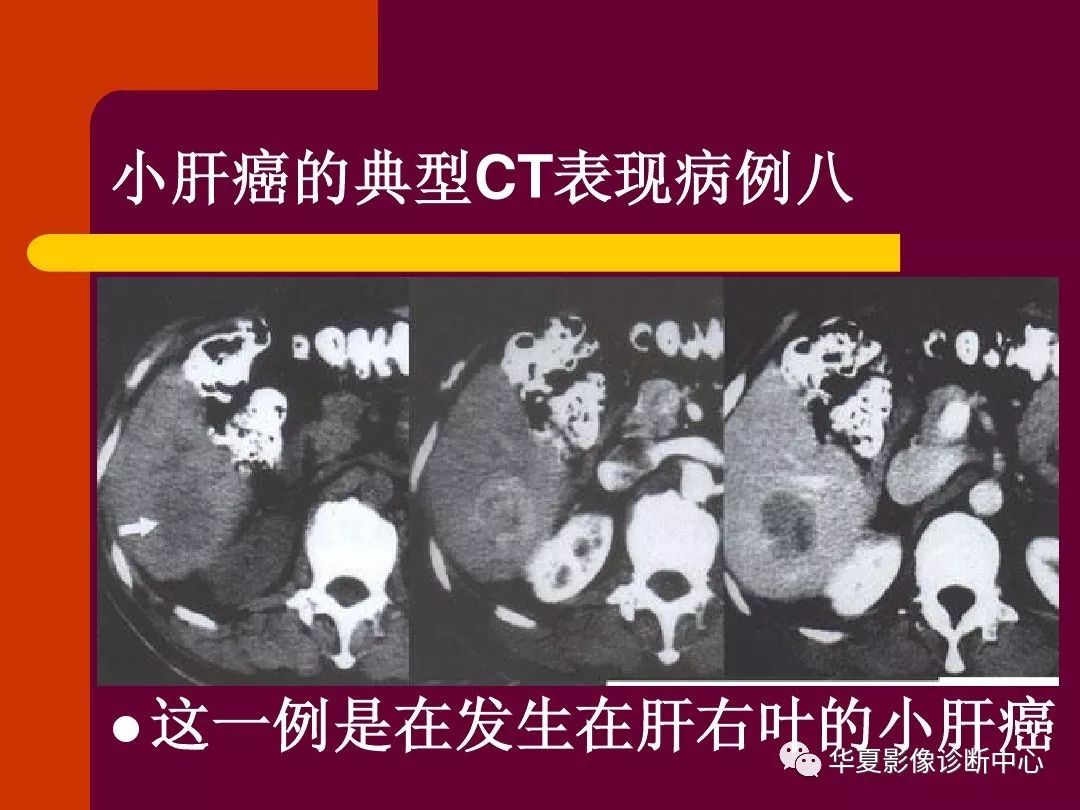 【影像基础】快来看,五花八门的小肝癌ct表现!