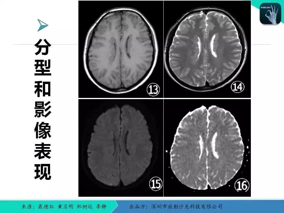 精品课件脑灰质异位症的影像诊断