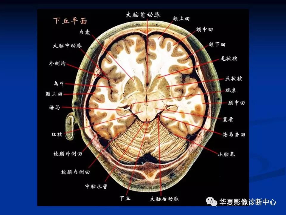 [影像回顾】头颅基本断层解剖