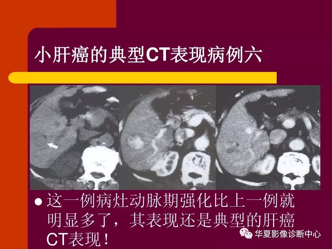 【影像基础】快来看,五花八门的小肝癌ct表现!