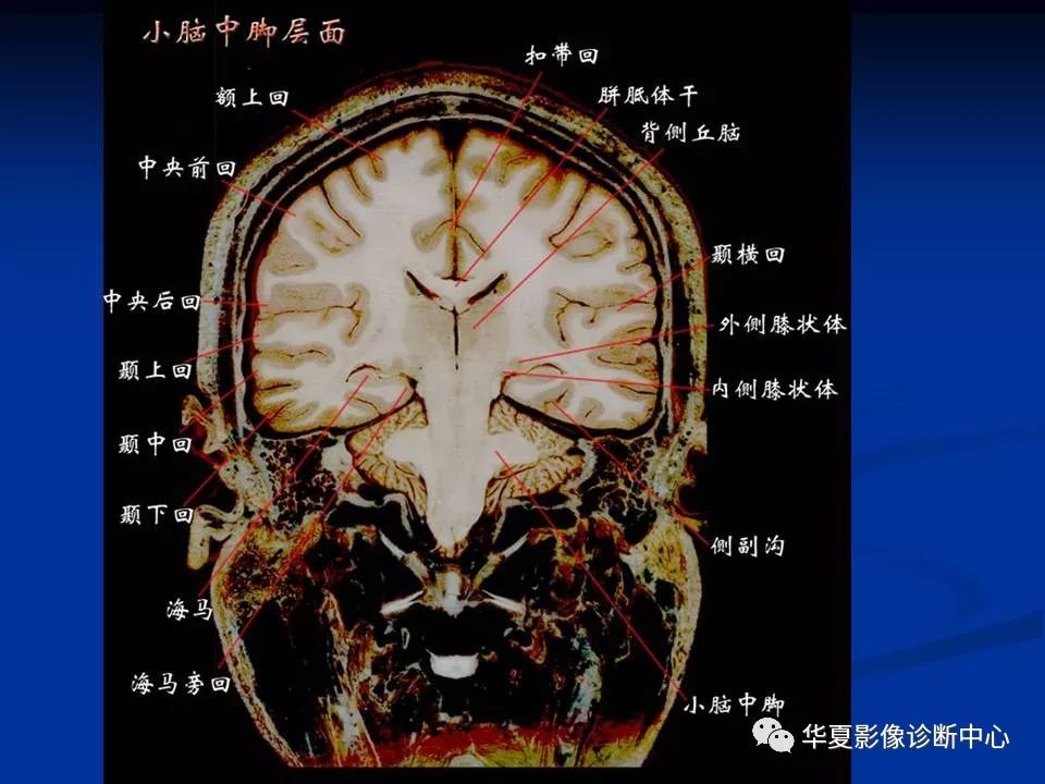 [影像回顾】头颅基本断层解剖
