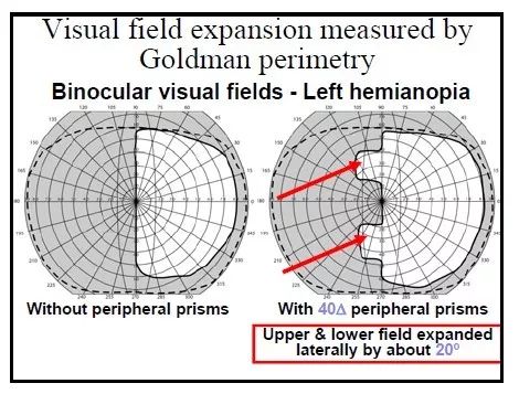 科普】偏盲患者福音!_视野