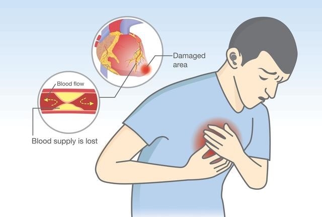 心肌梗死发作的前兆是什么?平时如何做才可以预防呢?