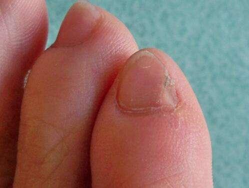 为什么很多中国人的小脚趾,都有两瓣指甲?今天总算知道了