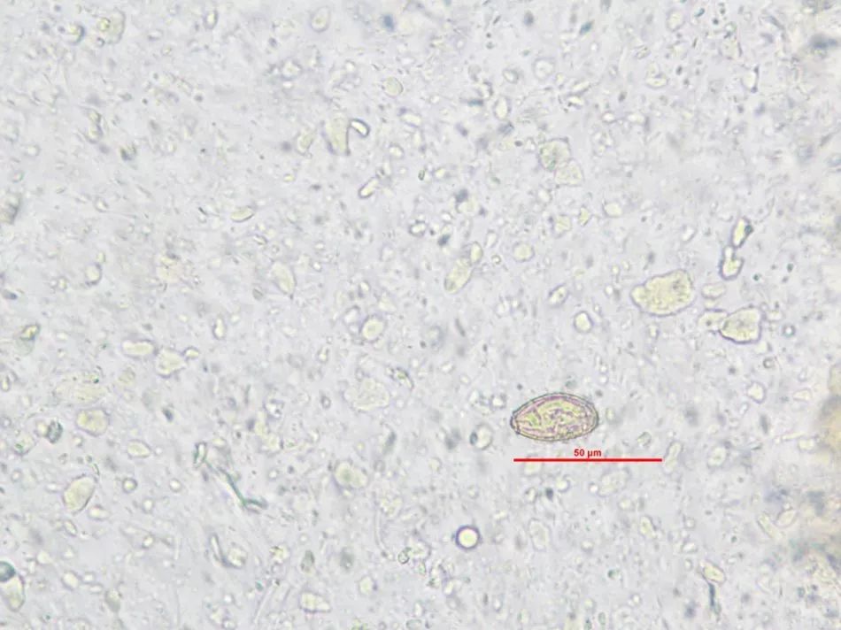 专家专栏 | 肝吸虫卵vs灵芝孢子,你还傻傻的分不清吗?