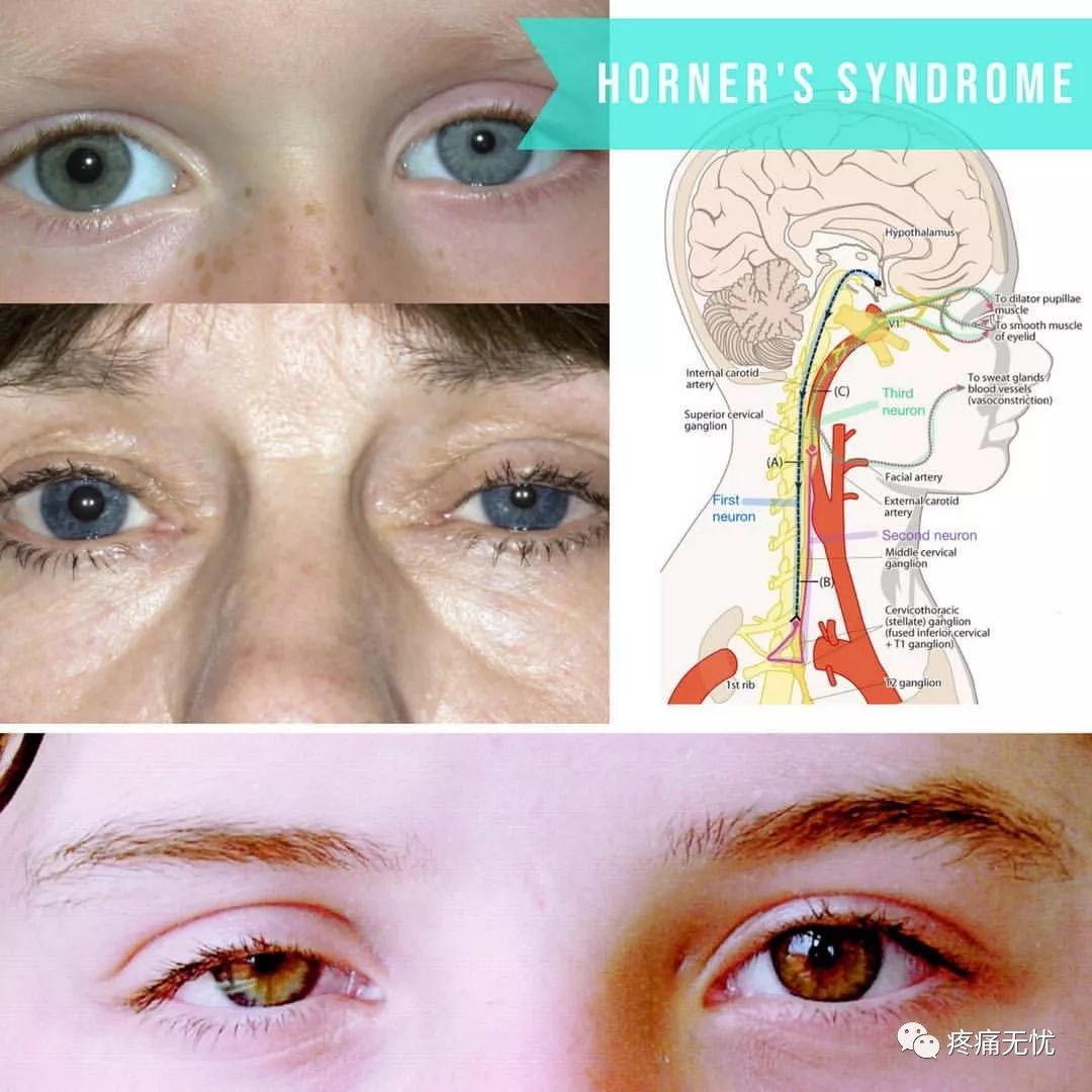 短暂时期出现霍纳综合征(如下图),即瞳孔缩小,眼睑下垂,眼球下陷