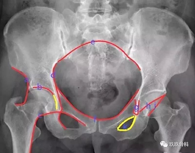 正常为光滑曲线,若不连续提示髋关节脱位或者股骨颈错位骨折.