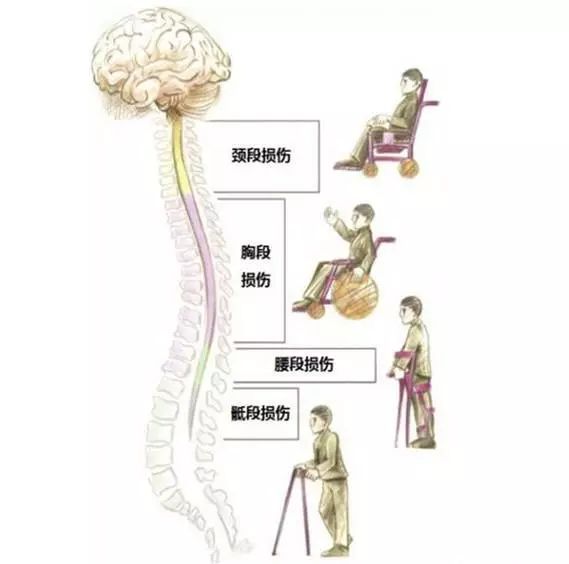 图示显示了患者运动双侧下肢感觉关键点(红点向下轻触觉及针刺觉减退