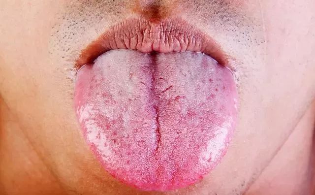 1,正常人舌像是颜色淡红,舌苔薄白; 2,阴虚病人舌头比较红,缺少舌苔