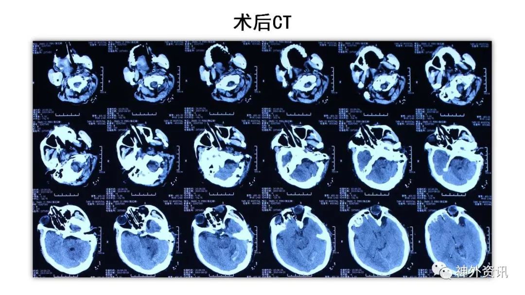 正海妙术视界赵天智副主任医师经乙状窦后联合远外侧入路切除岩斜枕骨