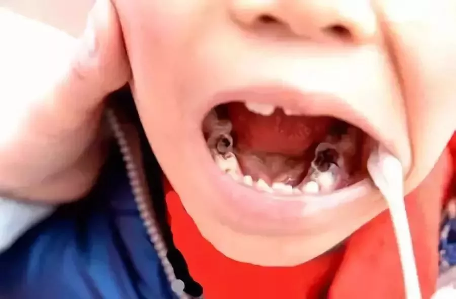 12岁前必须处理的20种儿童牙颌畸形!家长们一定要重视
