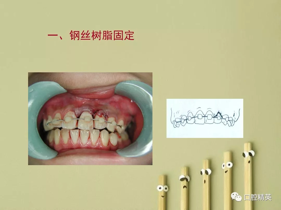 全口种植修复——人类的第三副牙齿_种植修复_苏州口腔医院
