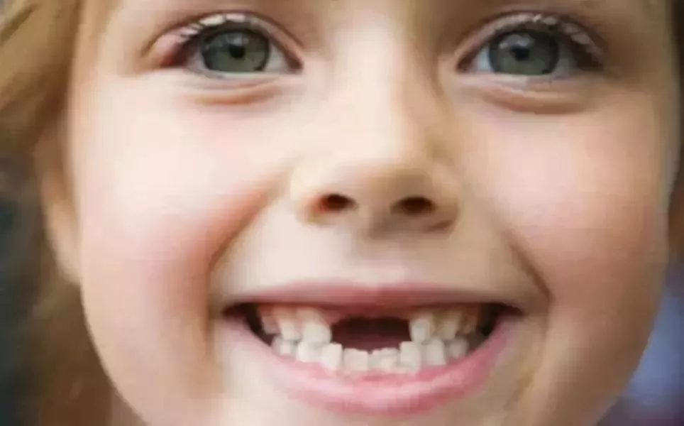 发现即矫正12岁前必须处理的20种儿童牙颌畸形