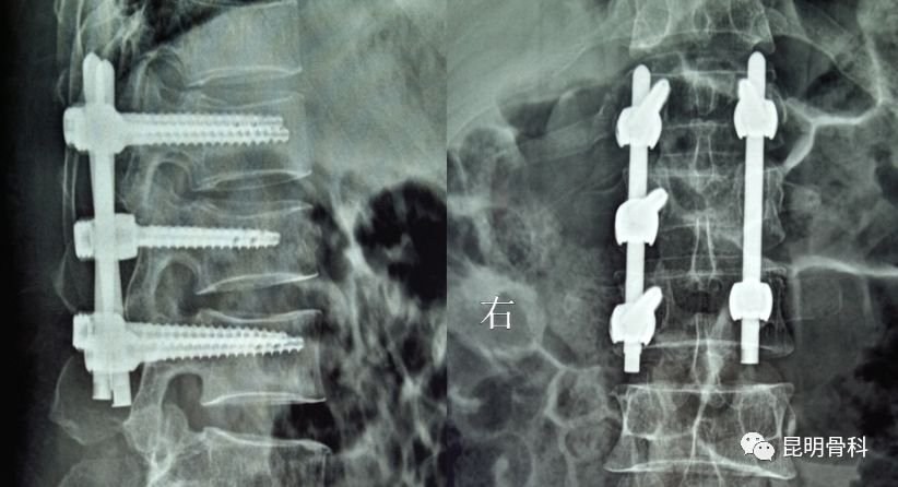 复查结果显示恢复良好据了解,经皮椎弓根钉棒系统内固定术是脊柱