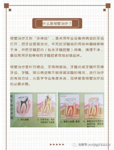 根管治疗后做个牙冠的必要性