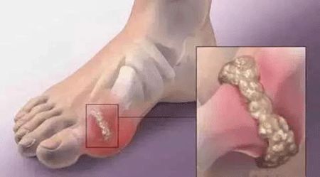 大脚趾处第一跖趾关节痛风症状